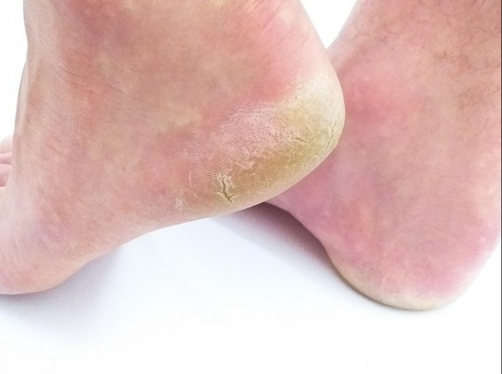 6 Causes Of Heel Pain Natural Foot Orthotics